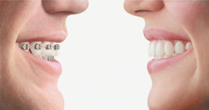 Picture of a Mouth with Braces and without Braces